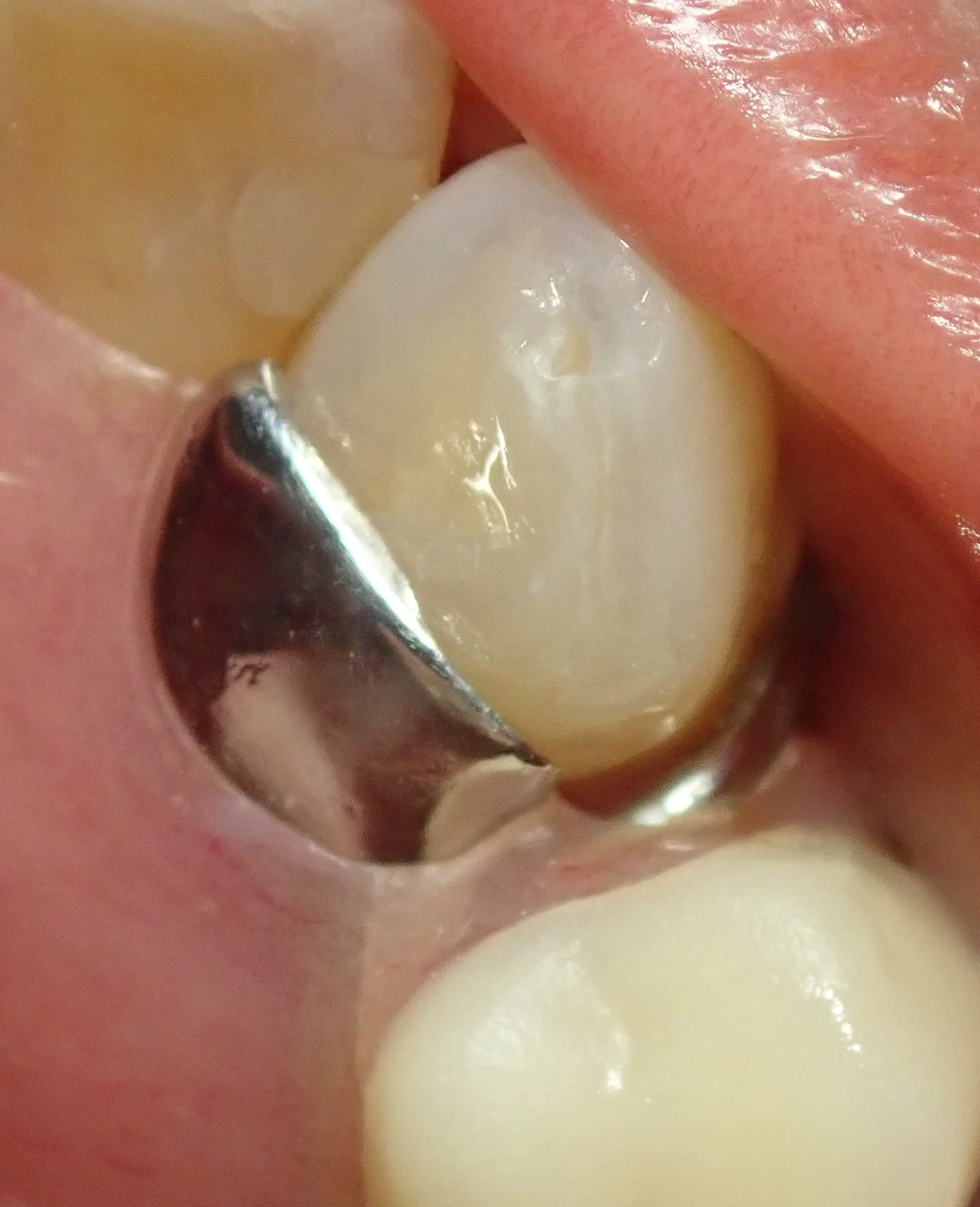 右上犬歯の白い詰め物｜坂寄歯科医院（取手市藤代） - 画像7