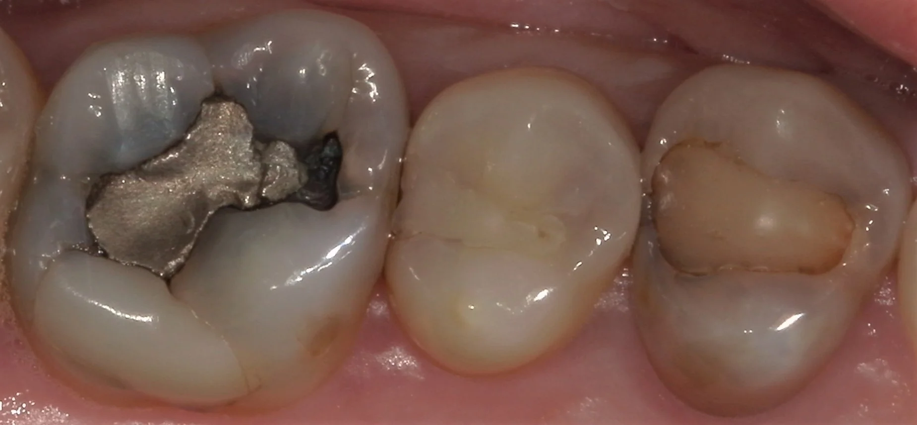 遠方から来院の方を白い詰め物にて治療。｜坂寄歯科医院（取手市藤代）
