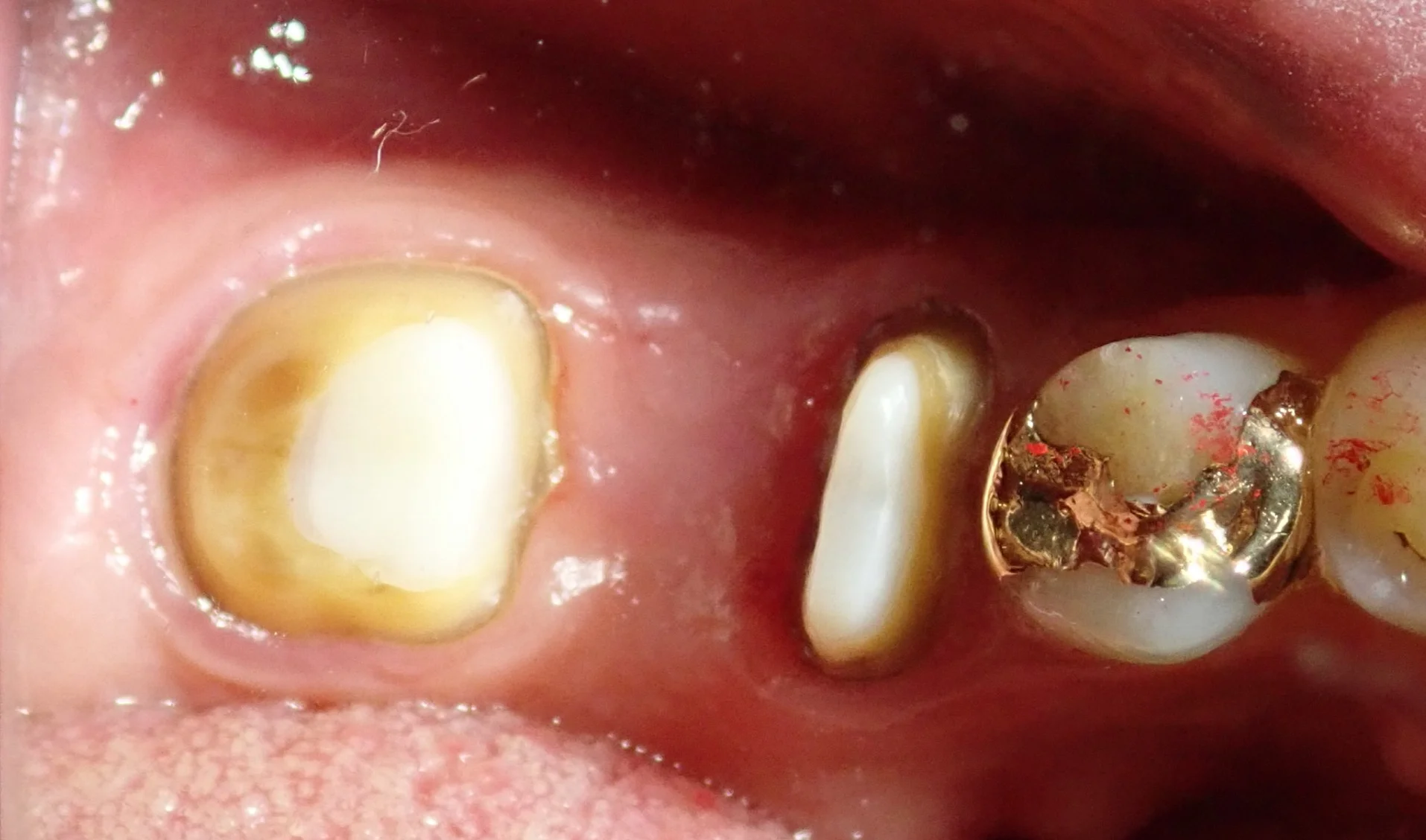 その抜歯ちょっと待って！｜坂寄歯科医院（取手市藤代） - 画像6