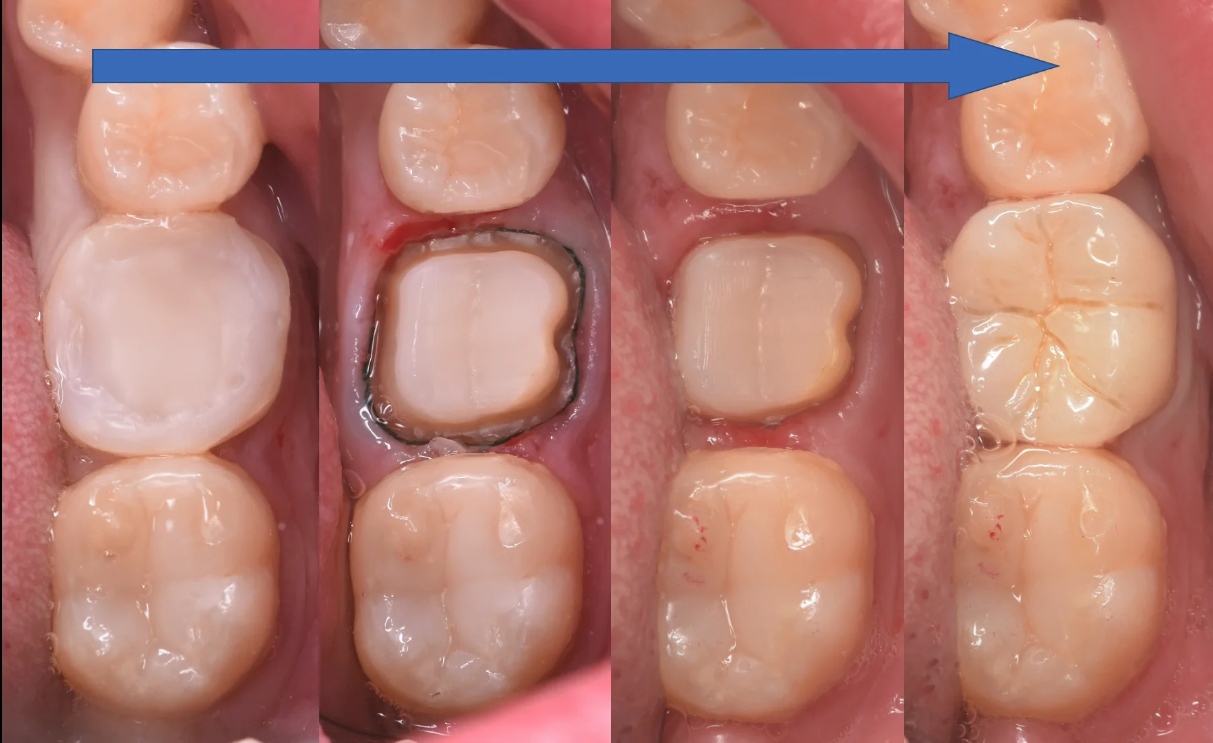 セラミックの被せ物|坂寄歯科医院(取手市藤代) - 画像6