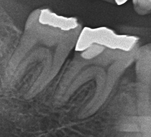 奥2本のダイレクトボンディング|坂寄歯科医院(取手市藤代)