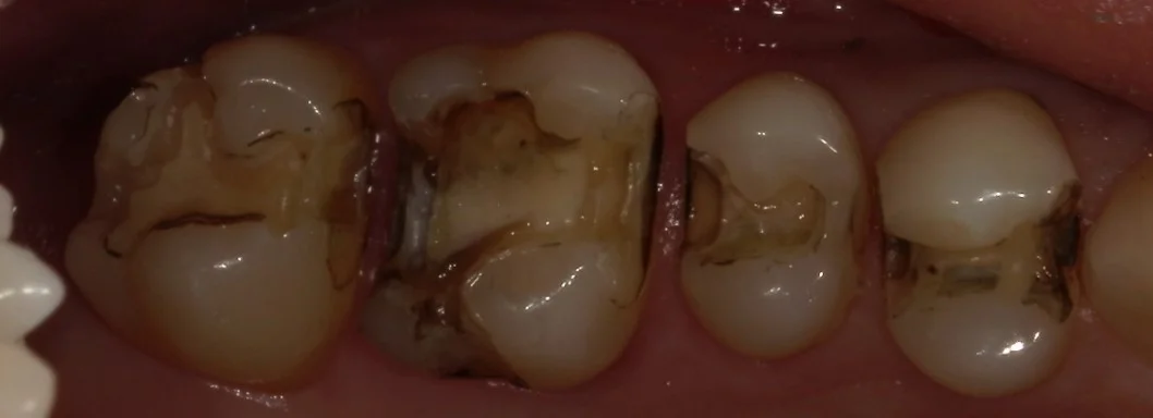 全体的に金属を白い詰め物に。|坂寄歯科医院(取手市藤代) - 画像2