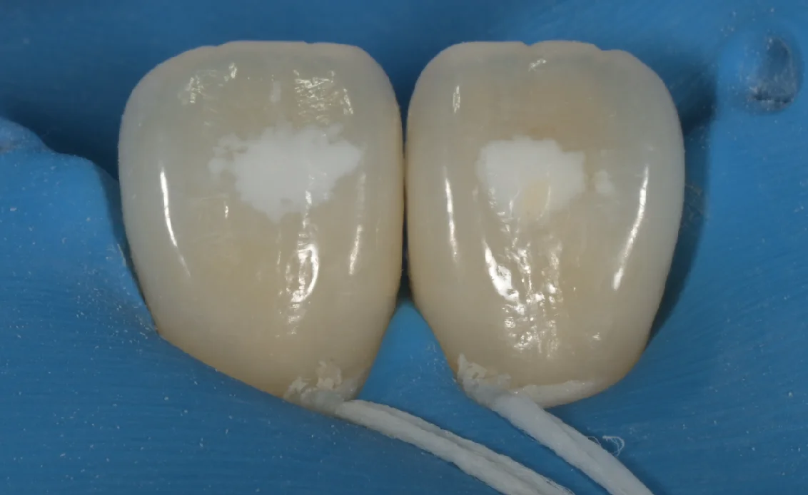 ICON治療。|坂寄歯科医院(取手市藤代) - 画像3