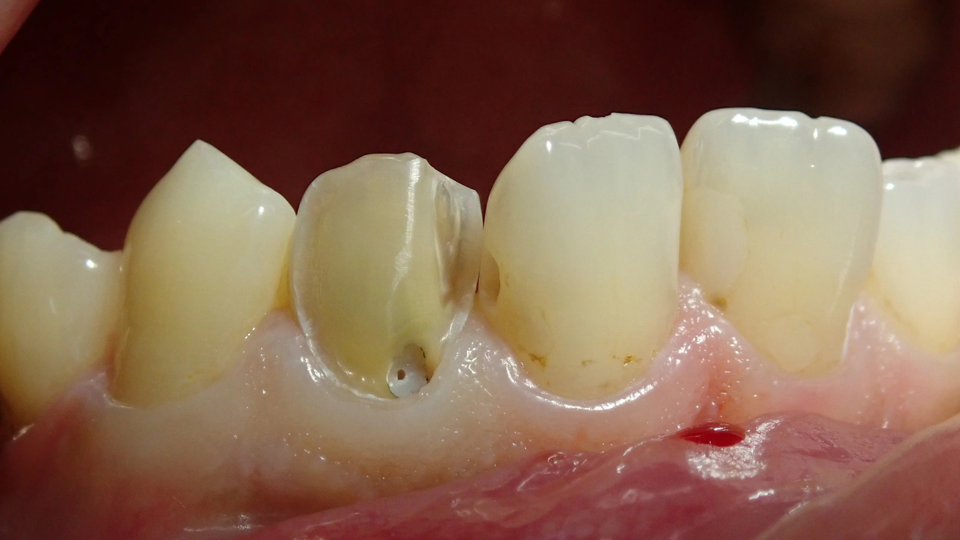 前歯のダイレクトベニア|坂寄歯科医院(取手市藤代) - 画像3