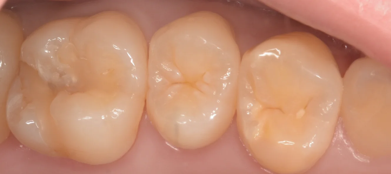 自費の白い詰め物。|坂寄歯科医院(取手市藤代)