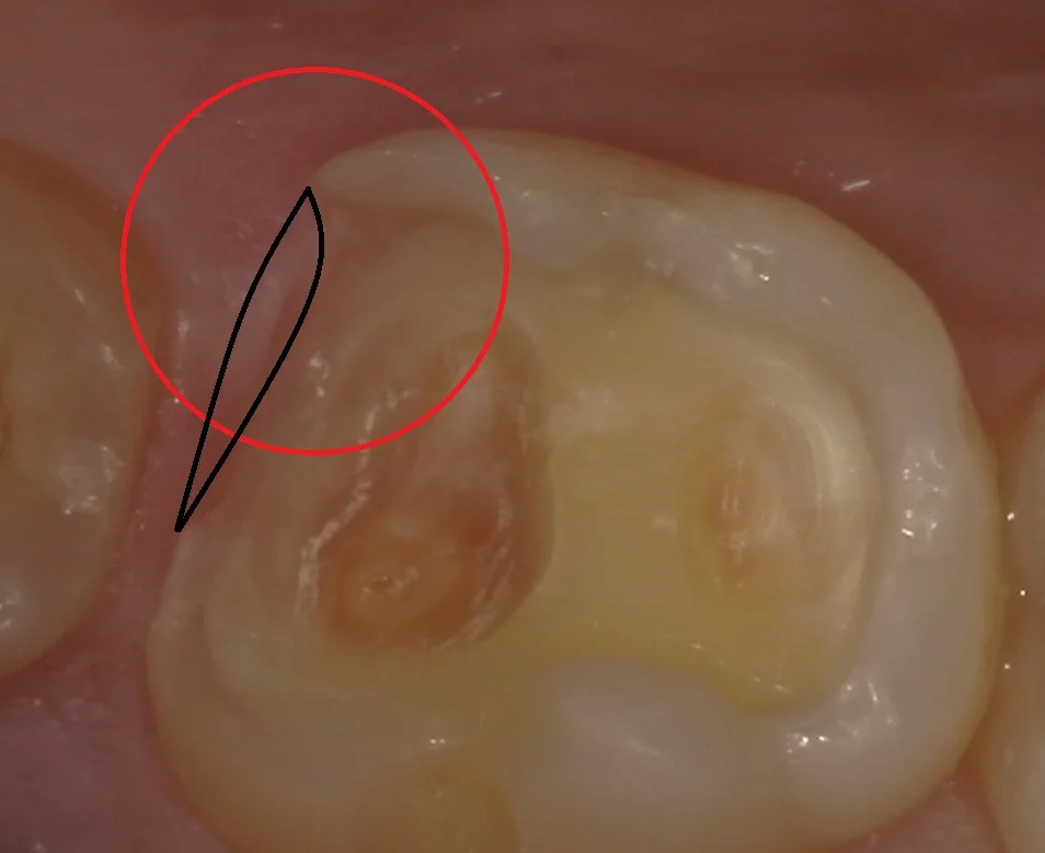 難易度の高い白い詰め物。|坂寄歯科医院(取手市藤代) - 画像3