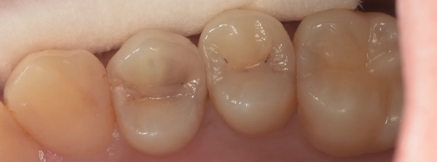 通常の保険診療。|坂寄歯科医院(取手市藤代)