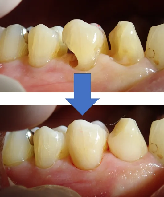3本連続ダイレクトボンディング|坂寄歯科医院(取手市藤代) - 画像5