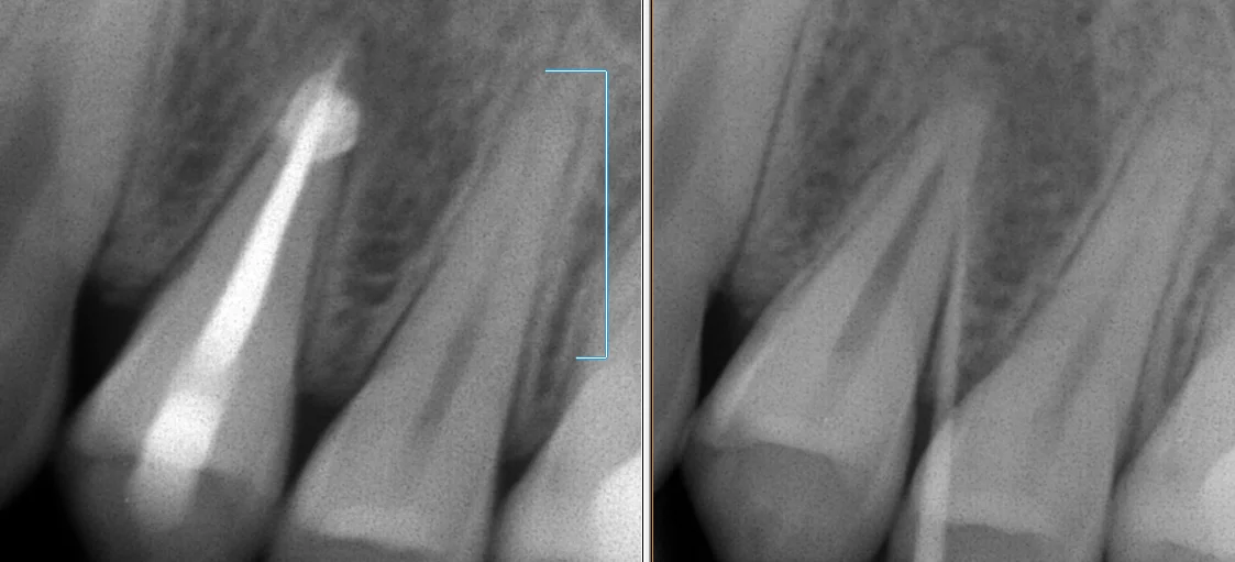 中心結節破折が原因で起こった神経の壊死を放置して、外部吸収が起こったケース｜坂寄歯科医院（取手市藤代） - 画像2