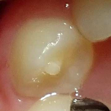 中心結節破折が原因で起こった神経の壊死を放置して、外部吸収が起こったケース｜坂寄歯科医院（取手市藤代）