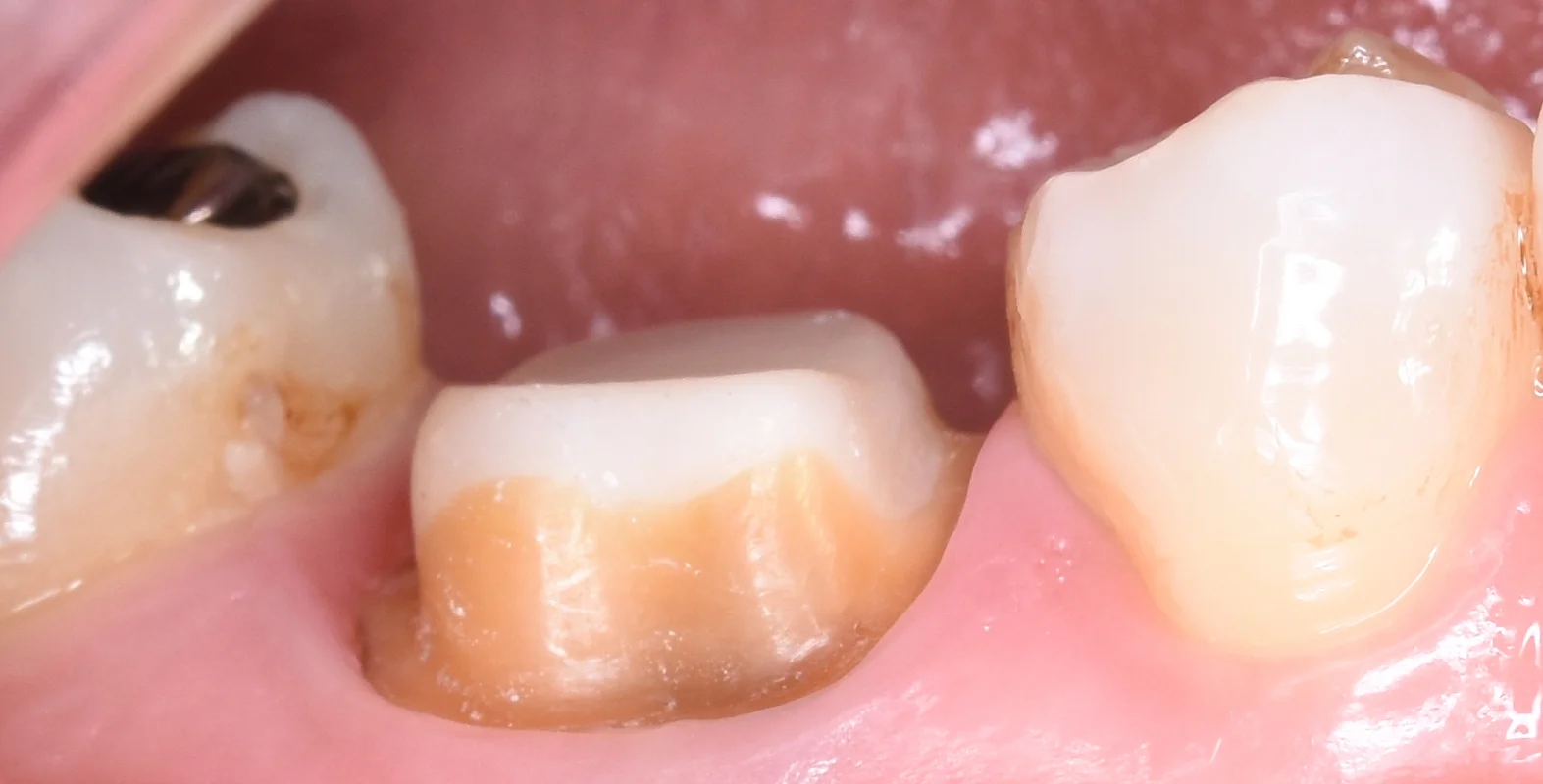 セラミックの被せ物|坂寄歯科医院(取手市藤代)