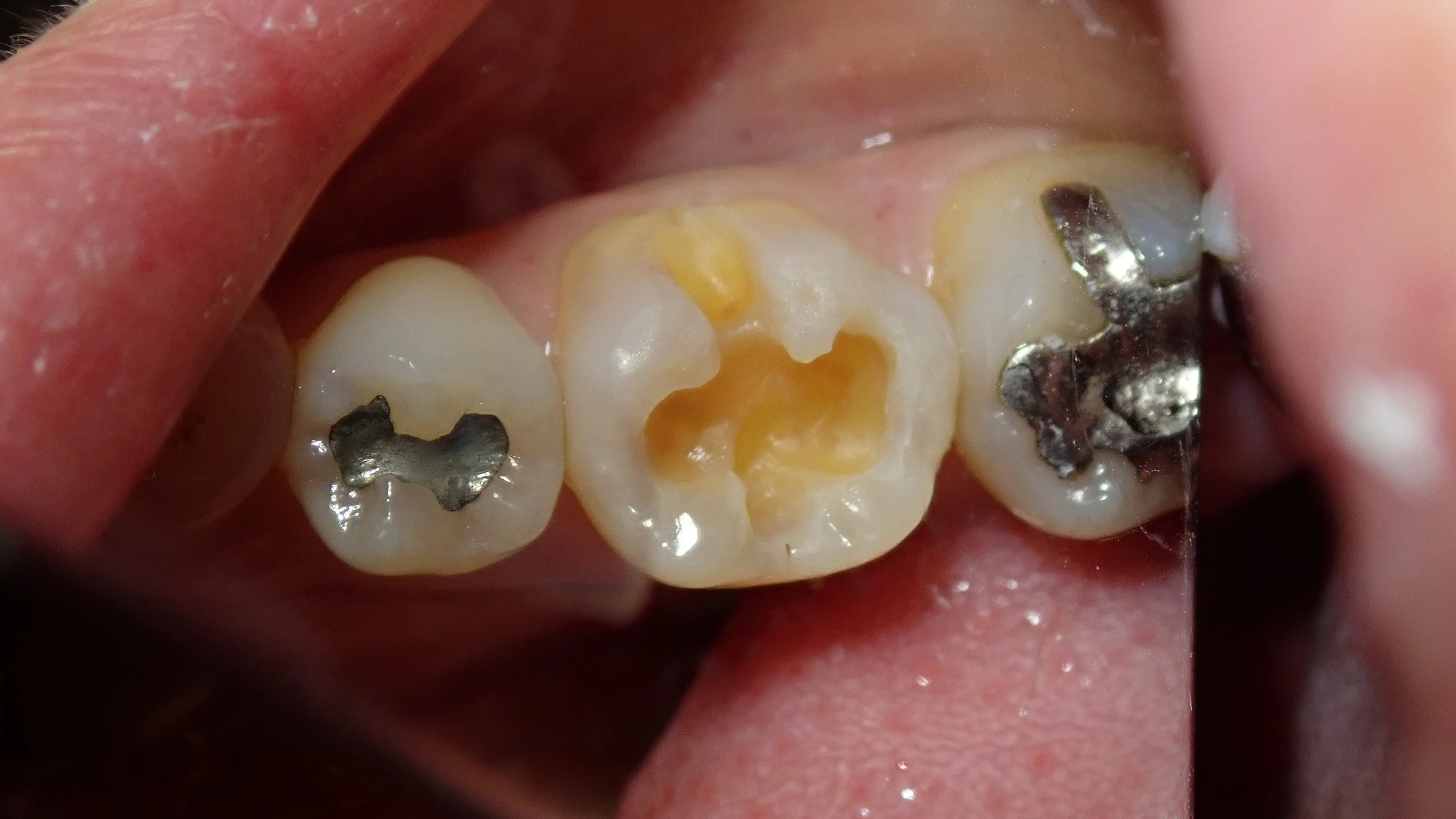 コンポジットレジン|坂寄歯科医院(取手市藤代) - 画像3