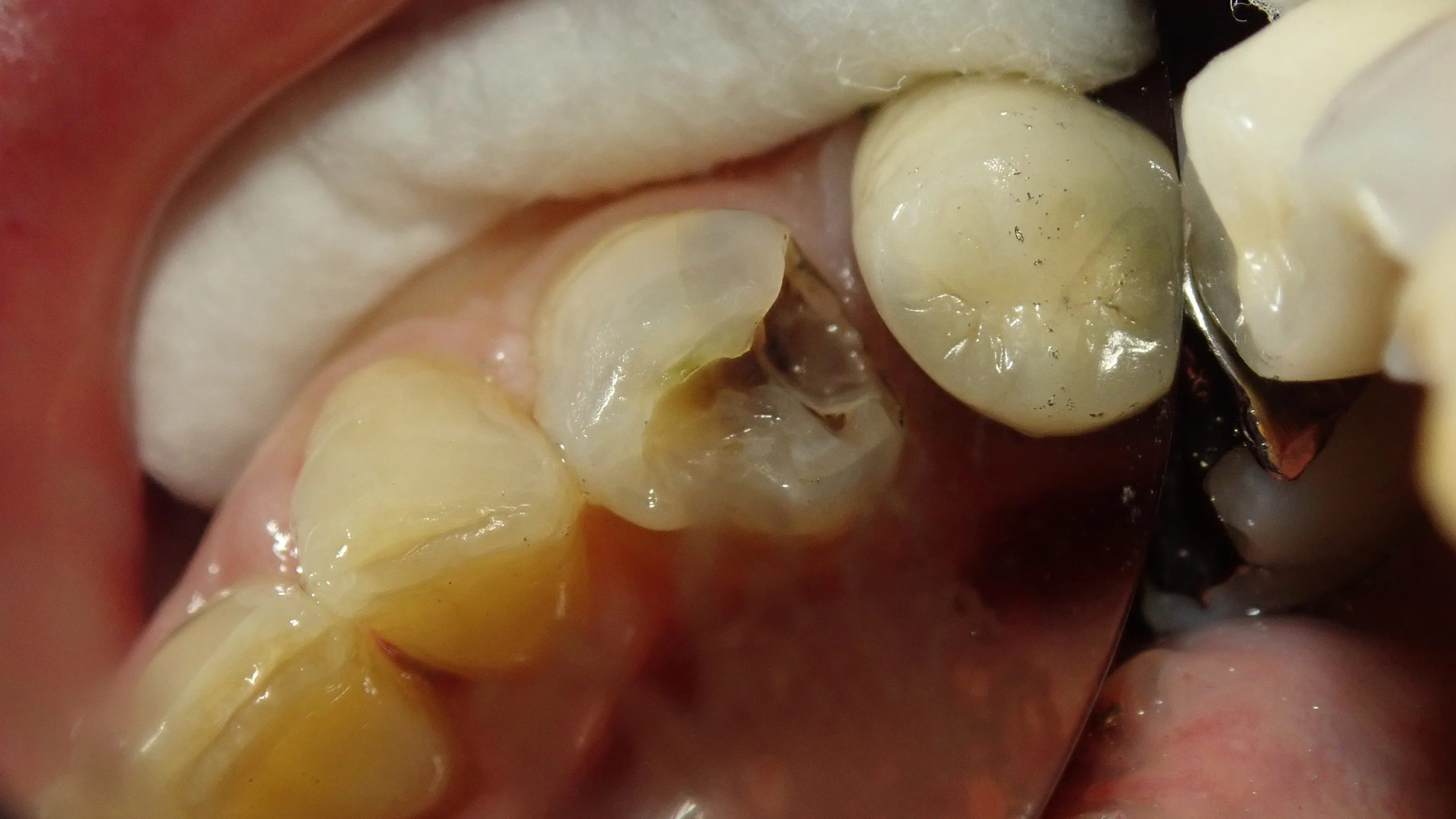 ダイレクトボンディング｜坂寄歯科医院（取手市藤代） - 画像2