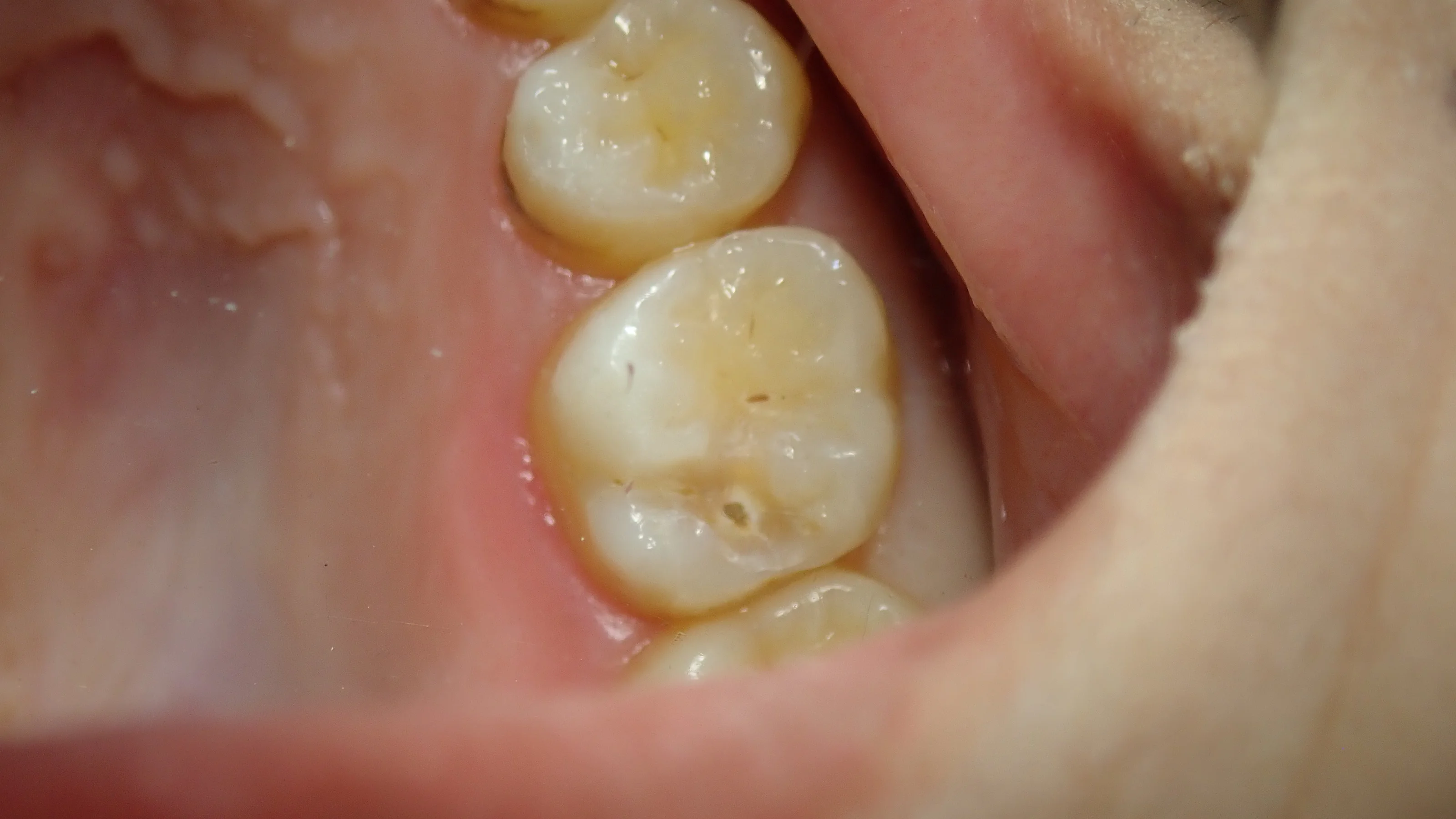 シールドレストレーション･･･？｜坂寄歯科医院（取手市藤代） - 画像3