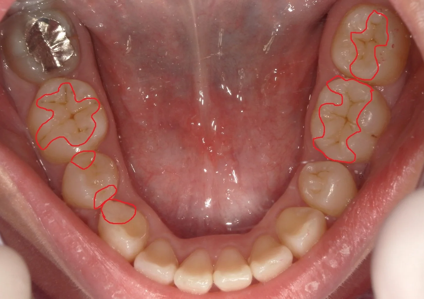 全顎的に白い詰め物で治した症例|坂寄歯科医院(取手市藤代) - 画像4