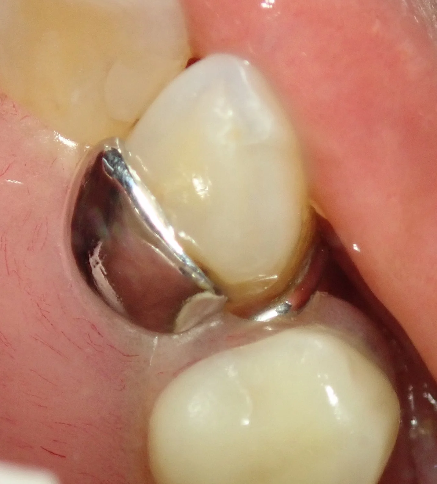 右上犬歯の白い詰め物｜坂寄歯科医院（取手市藤代）