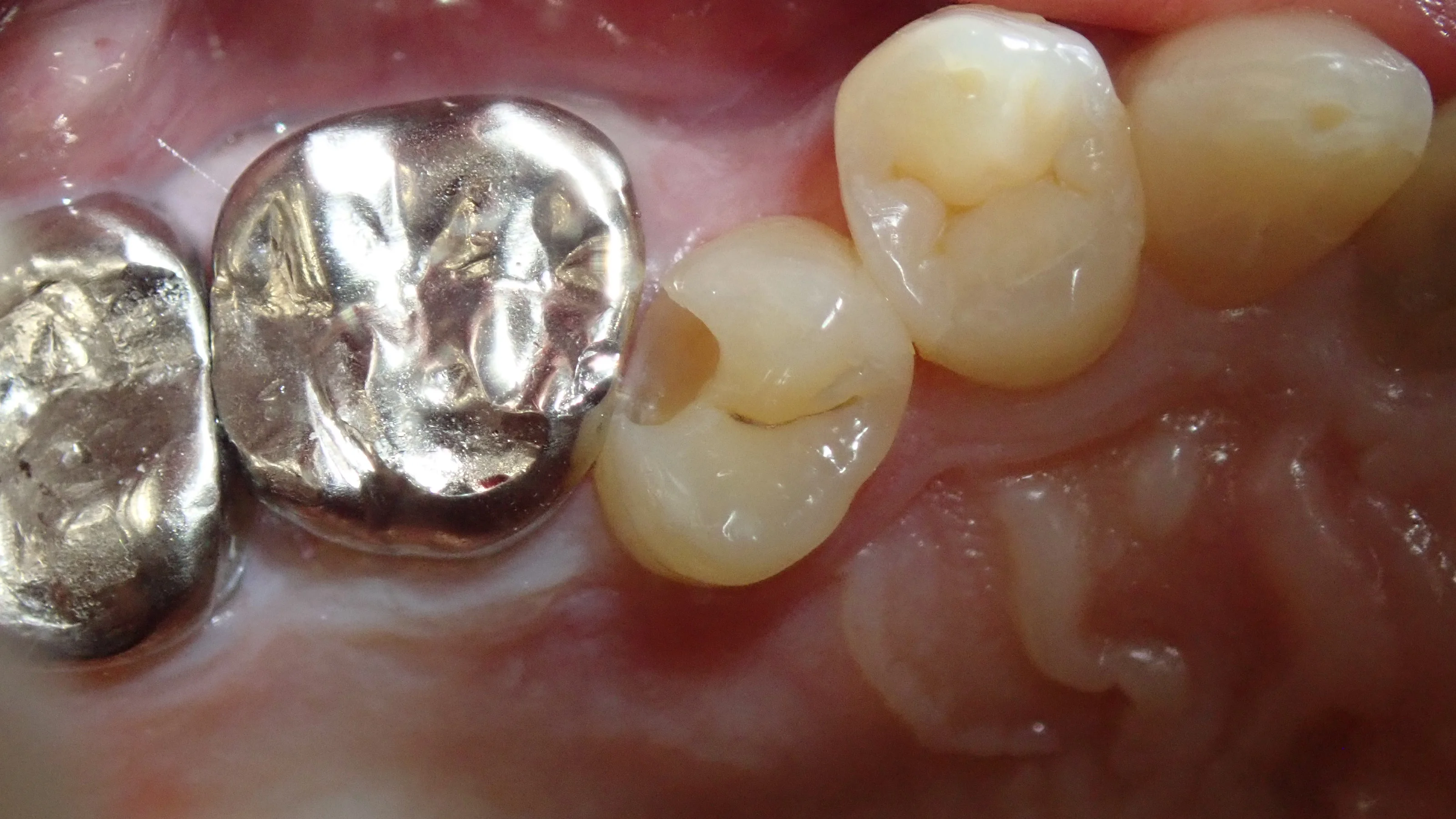 左上3本まとめてダイレクトボンディング｜坂寄歯科医院（取手市藤代） - 画像6