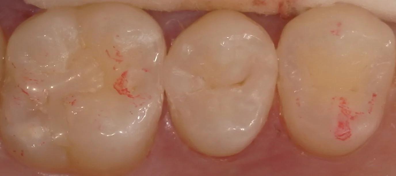 遠方から白い詰め物での治療を求めて・・・｜坂寄歯科医院（取手市藤代） - 画像5