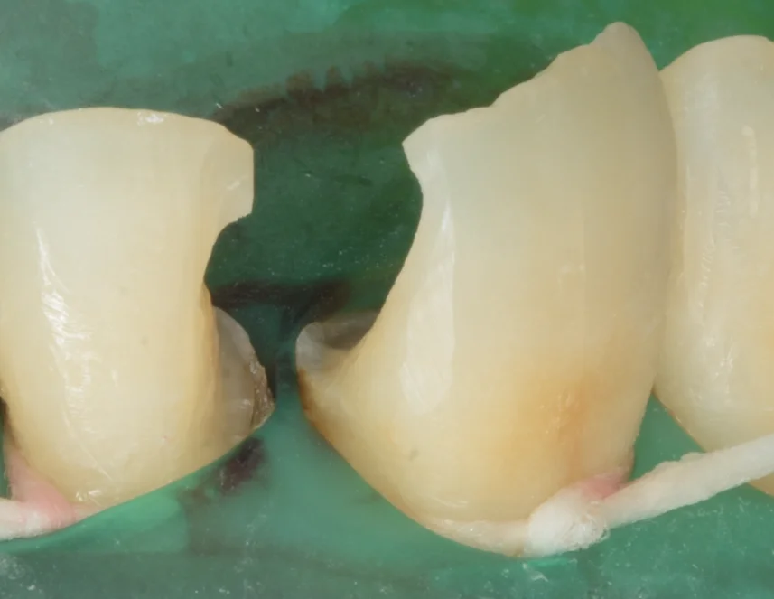 不適合なレジンを再治療。|坂寄歯科医院(取手市藤代) - 画像2