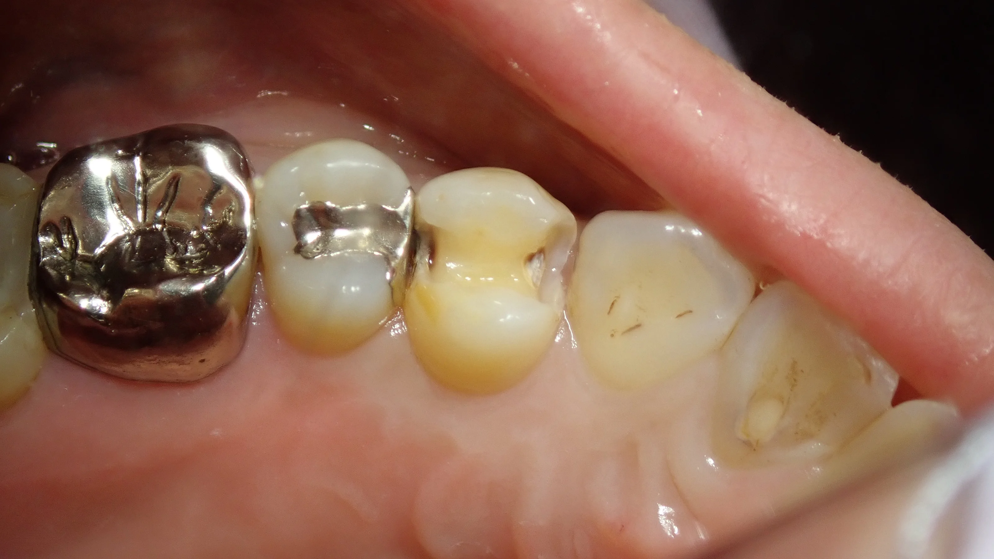 小さい奥歯(小臼歯)の白い詰め物|坂寄歯科医院(取手市藤代) - 画像4