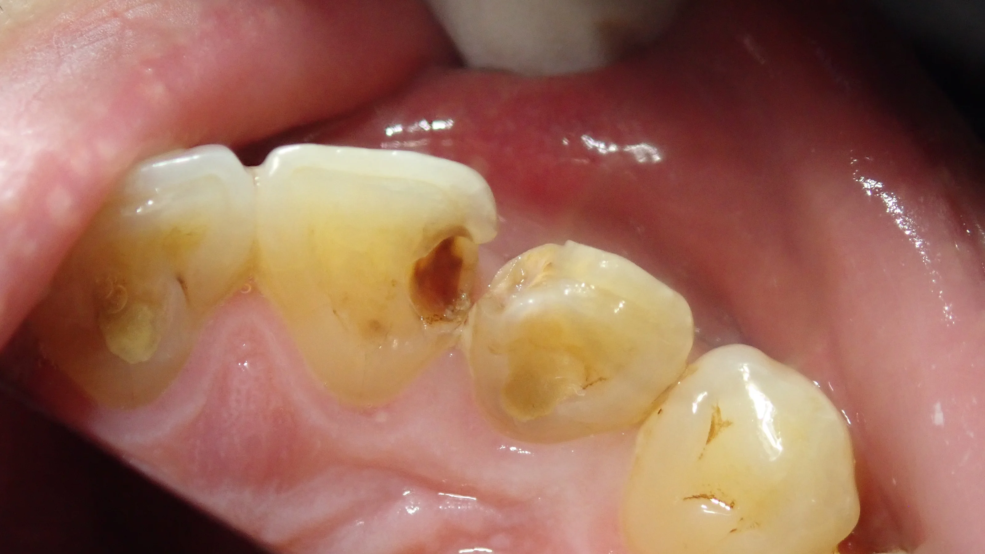 前歯の白い詰め物｜坂寄歯科医院（取手市藤代） - 画像4