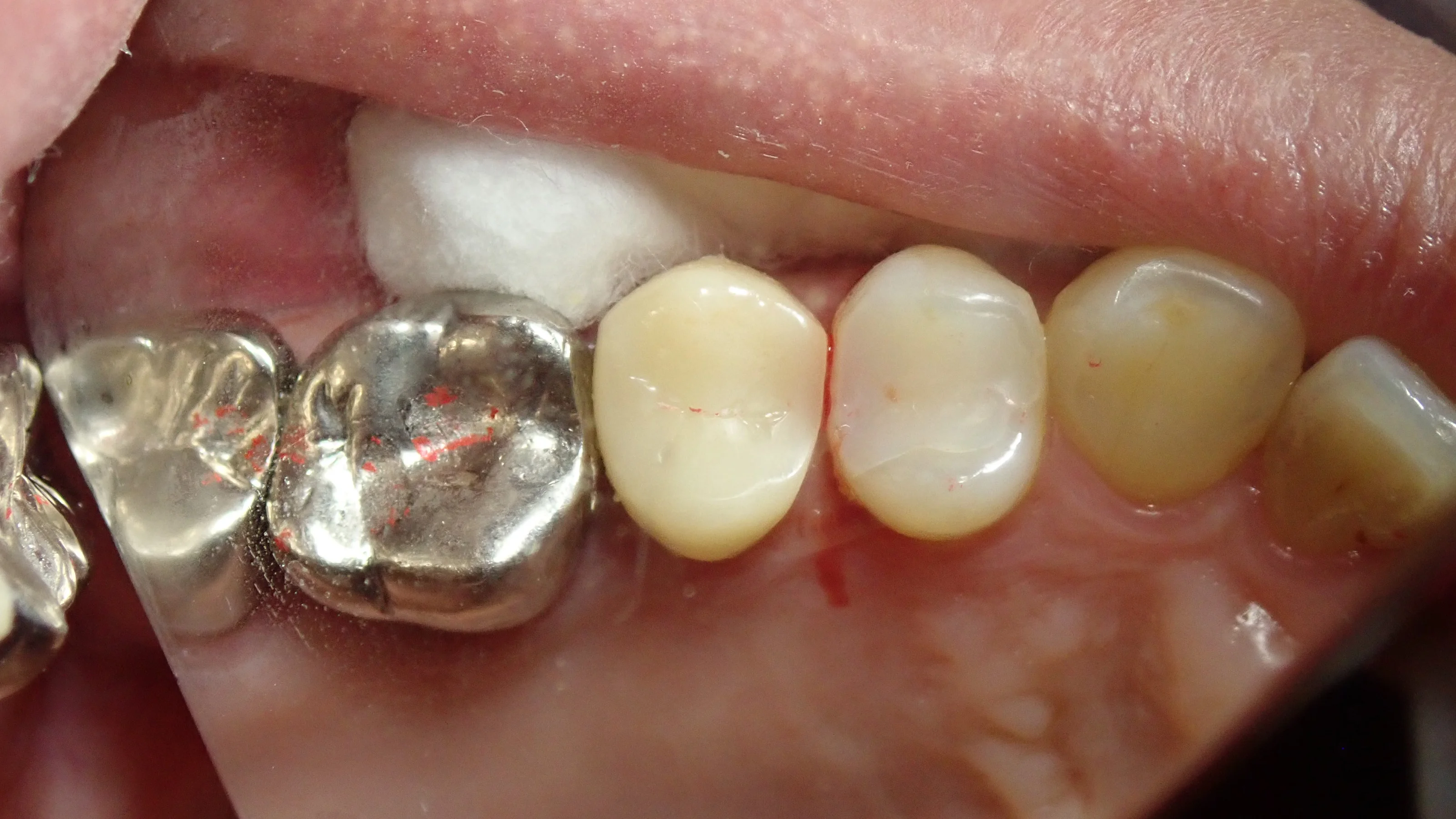 保険の白い被せ物|坂寄歯科医院(取手市藤代) - 画像3