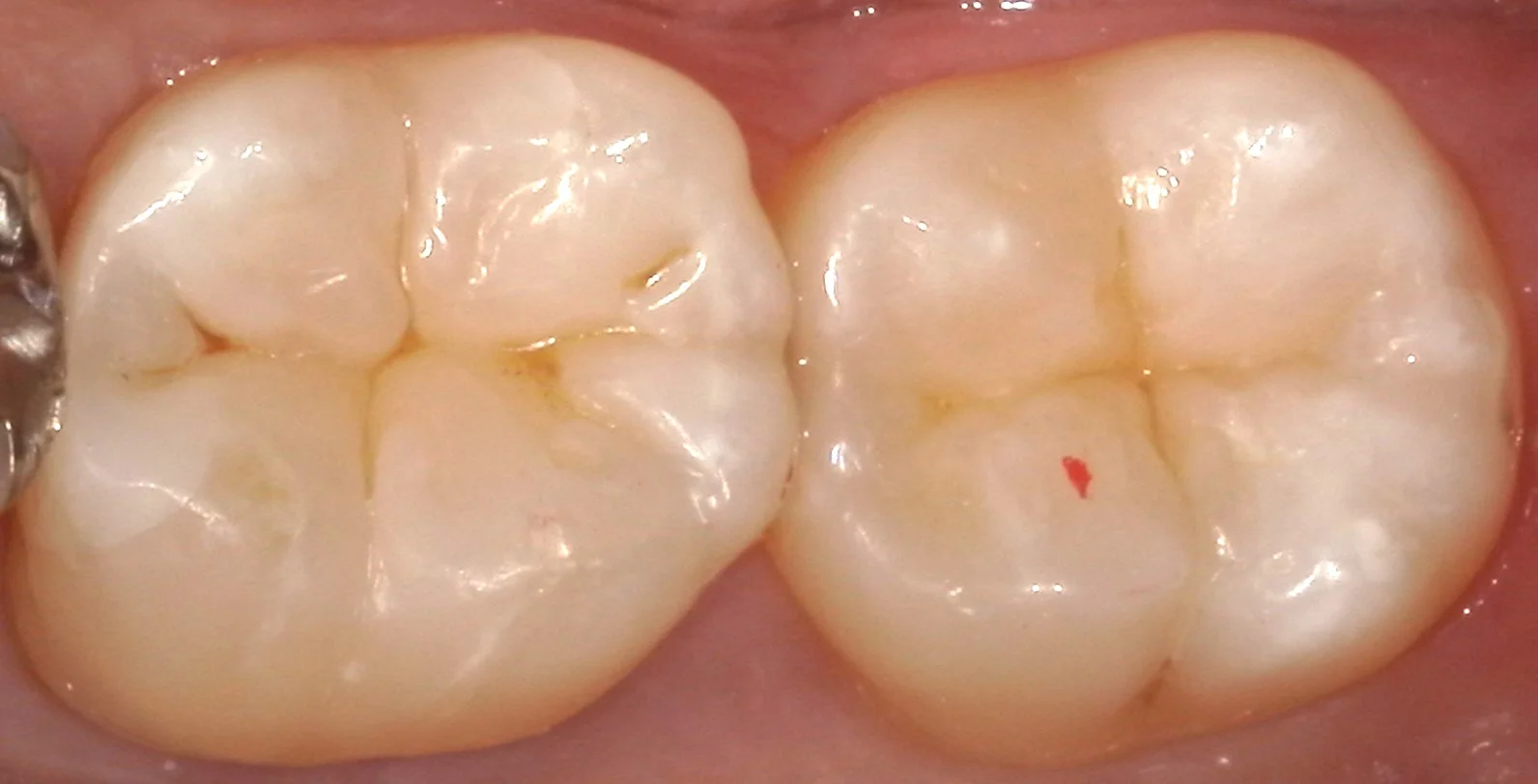 奥歯の自費の白い詰め物。術後数週間後もあります。|坂寄歯科医院(取手市藤代) - 画像4