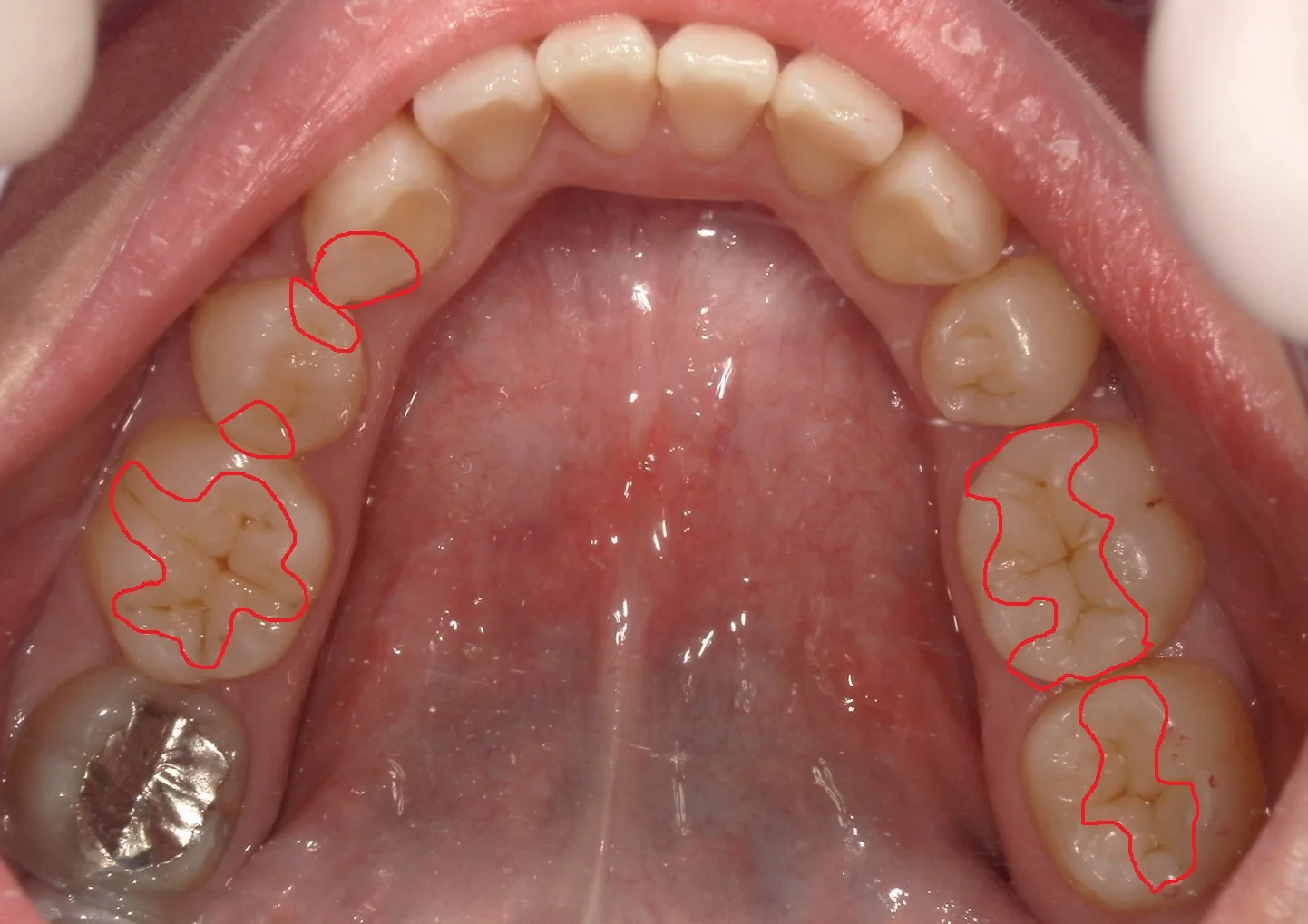 全体的に自費の白い詰め物で治したケース。｜坂寄歯科医院（取手市藤代） - 画像4