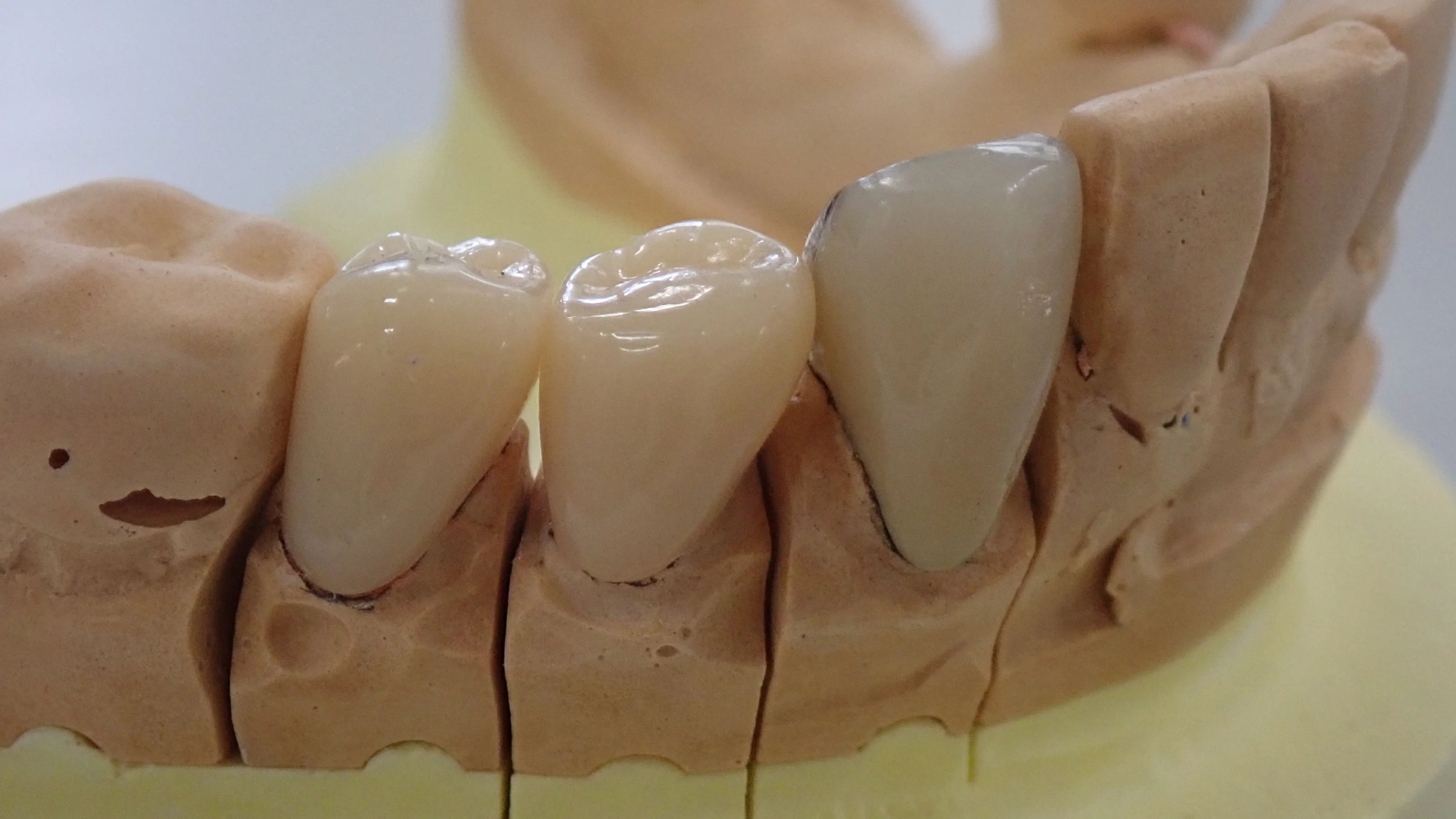 CAD/CAM冠について｜坂寄歯科医院（取手市藤代）