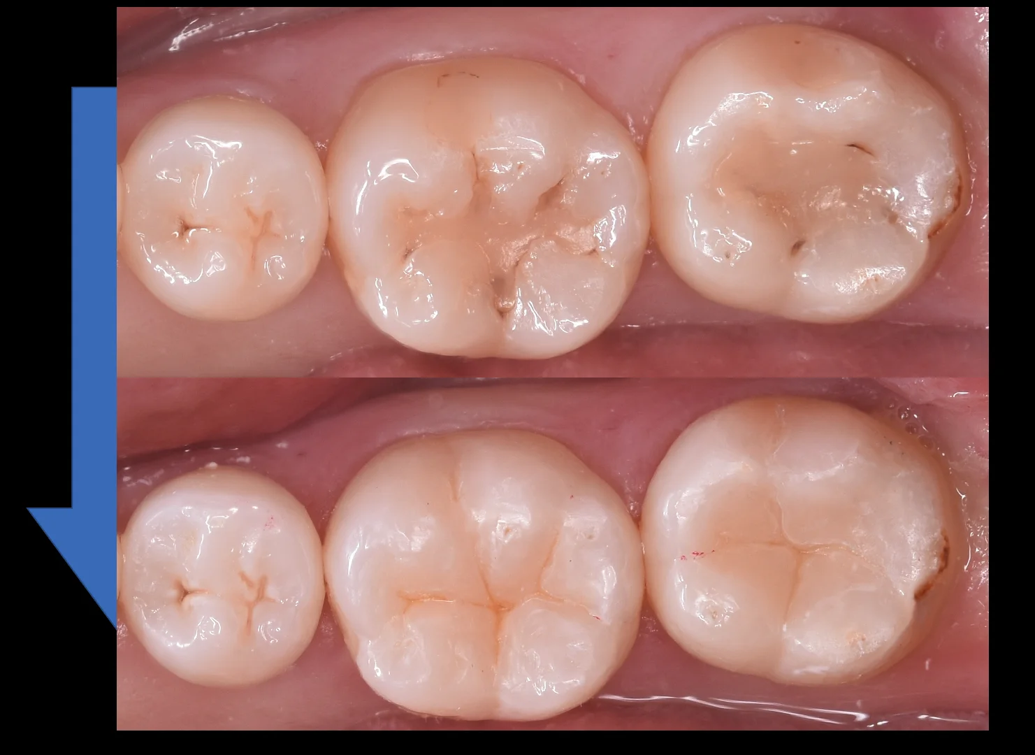 他県にて勤務中の歯科衛生士の方の治療。｜坂寄歯科医院（取手市藤代） - 画像5