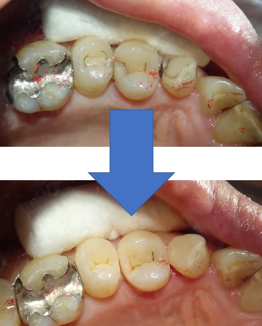 3本連続ダイレクトボンディング|坂寄歯科医院(取手市藤代) - 画像4