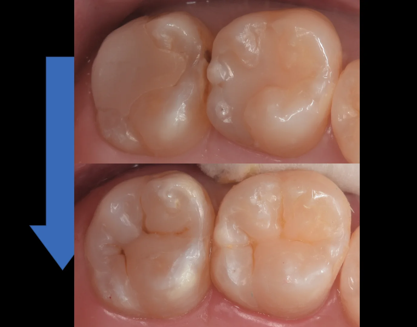 他院で入れたセラミックをダイレクトボンディングに。|坂寄歯科医院(取手市藤代) - 画像5