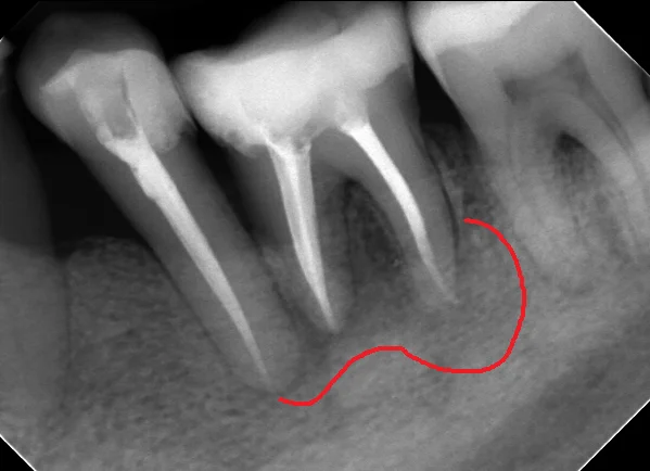 レジンでは無理ですって！再び･･･｡｜坂寄歯科医院（取手市藤代） - 画像2