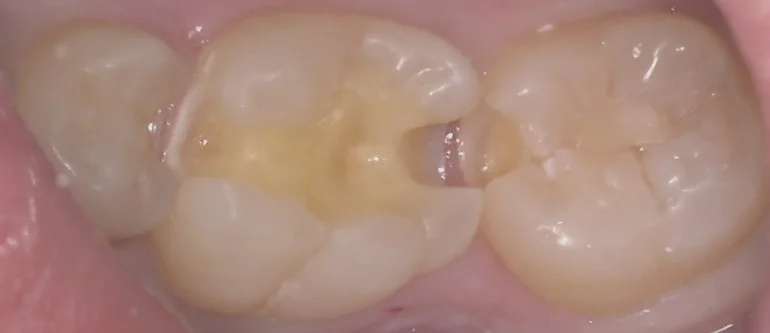 複数本を一気に治療。｜坂寄歯科医院（取手市藤代） - 画像2