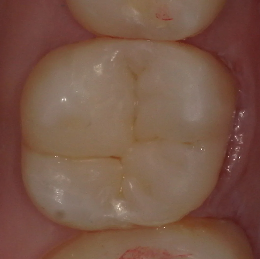 歯の側面も同時に治療したケース。|坂寄歯科医院(取手市藤代) - 画像5