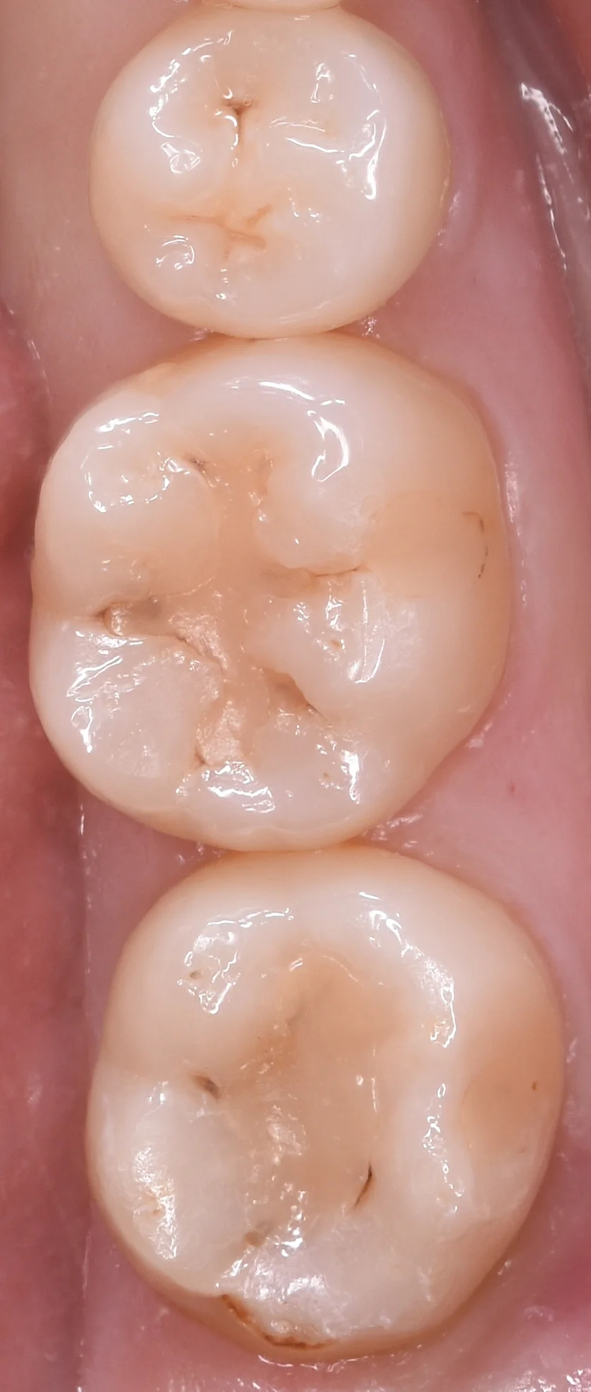 他県にて勤務中の歯科衛生士の方の治療。｜坂寄歯科医院（取手市藤代）