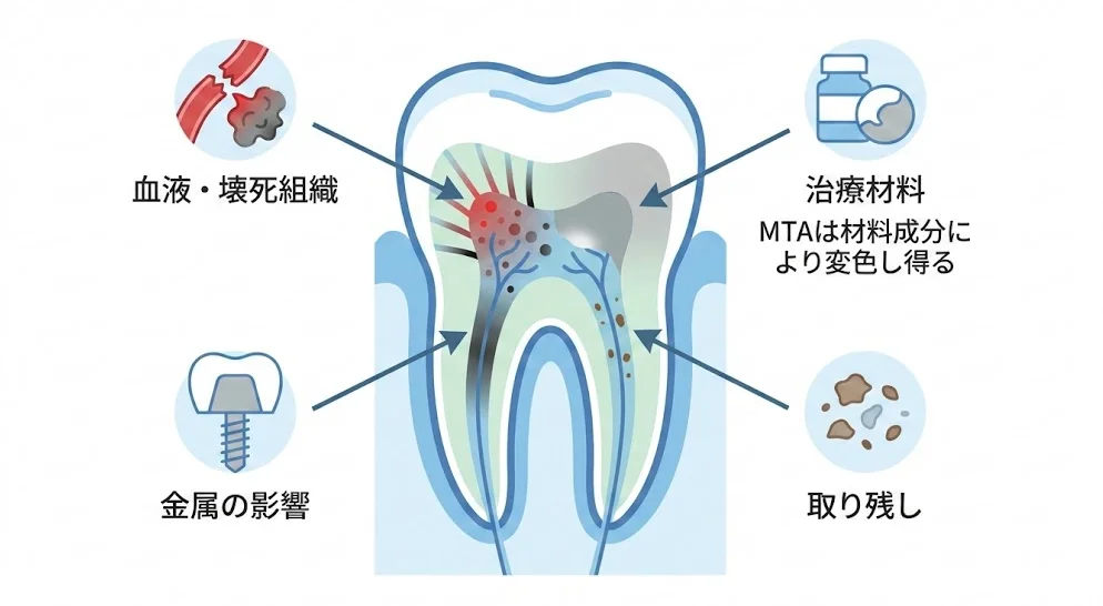 神経を取った歯(失活歯)が黒ずむ主な原因(血液や壊死組織の分解、根管治療材料の着色、金属コアの透け、髄室内の清掃不足)を模式図で解説するイラスト。気になる変色は原因が複数あり、歯科医院での診査が重要。