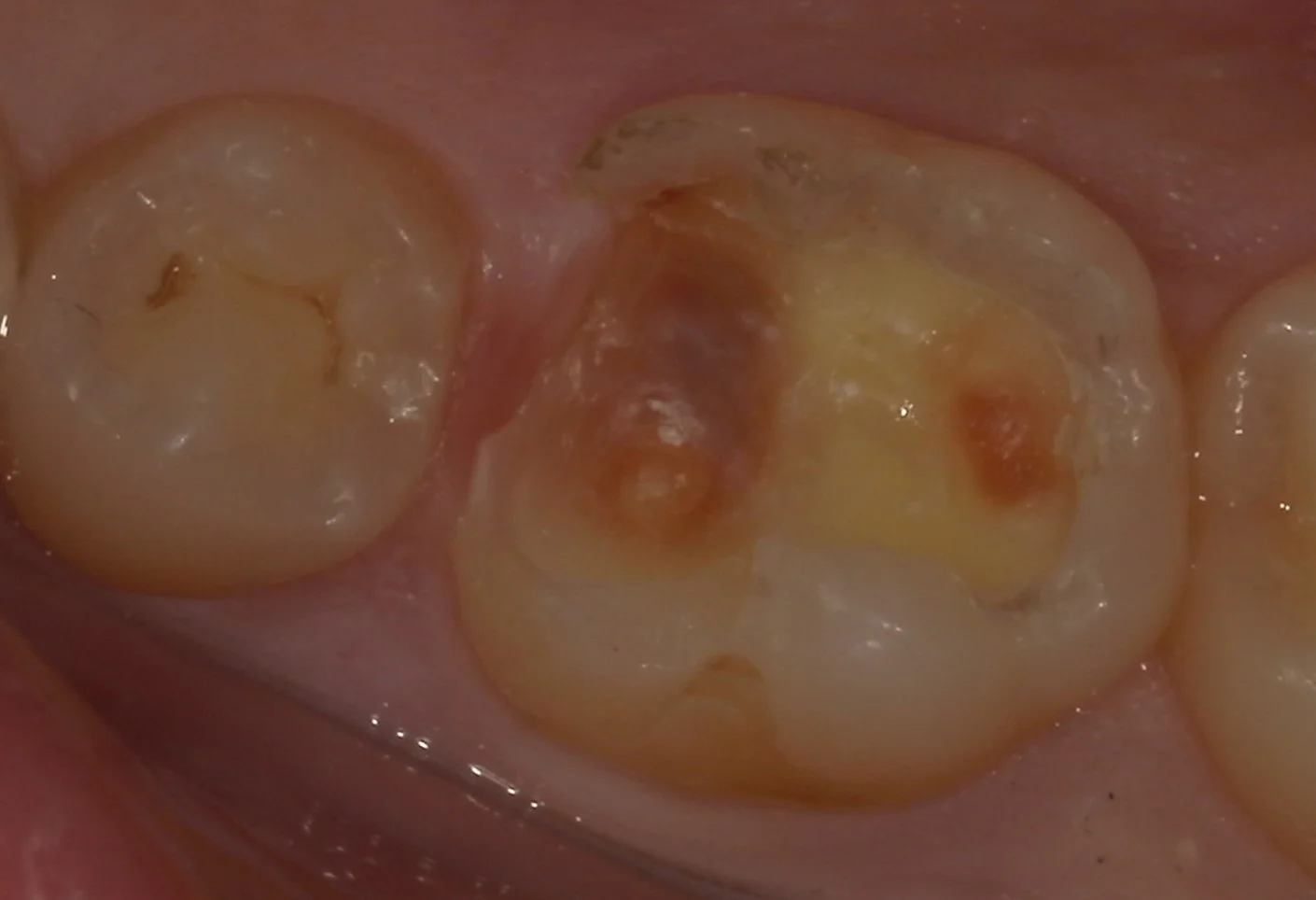 難易度の高い白い詰め物。|坂寄歯科医院(取手市藤代) - 画像2