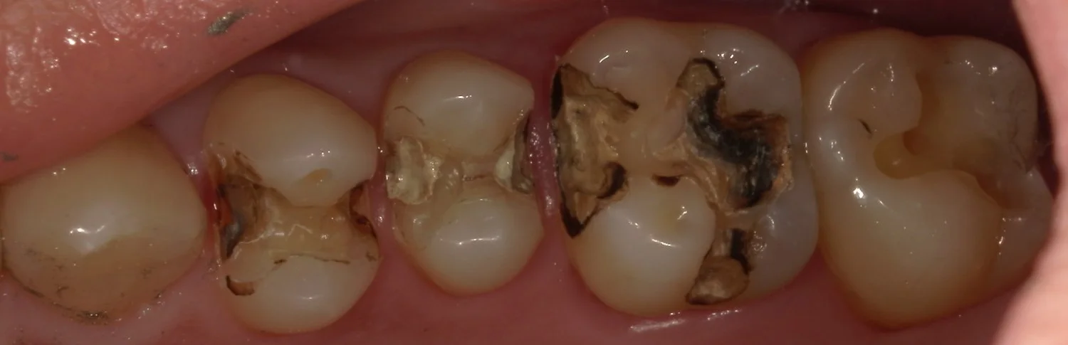 全体的に金属を白くしたいという方の治療｜坂寄歯科医院（取手市藤代） - 画像2