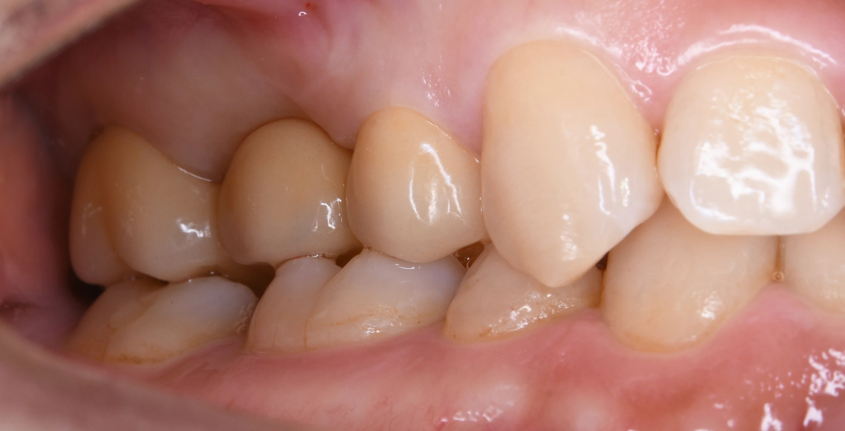 セラミックのブリッジ|坂寄歯科医院(取手市藤代) - 画像2