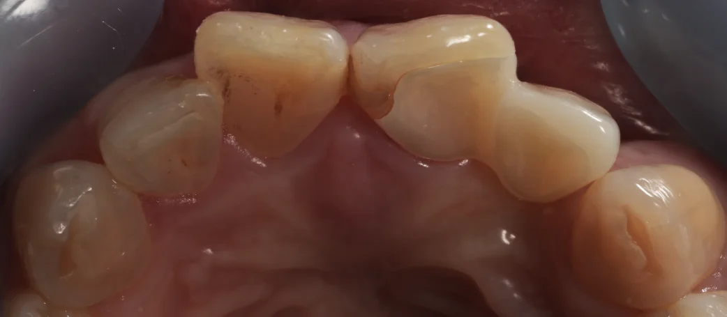 審美治療+歯質保存:延長セラミックブリッジ|坂寄歯科医院(取手市藤代) - 画像4