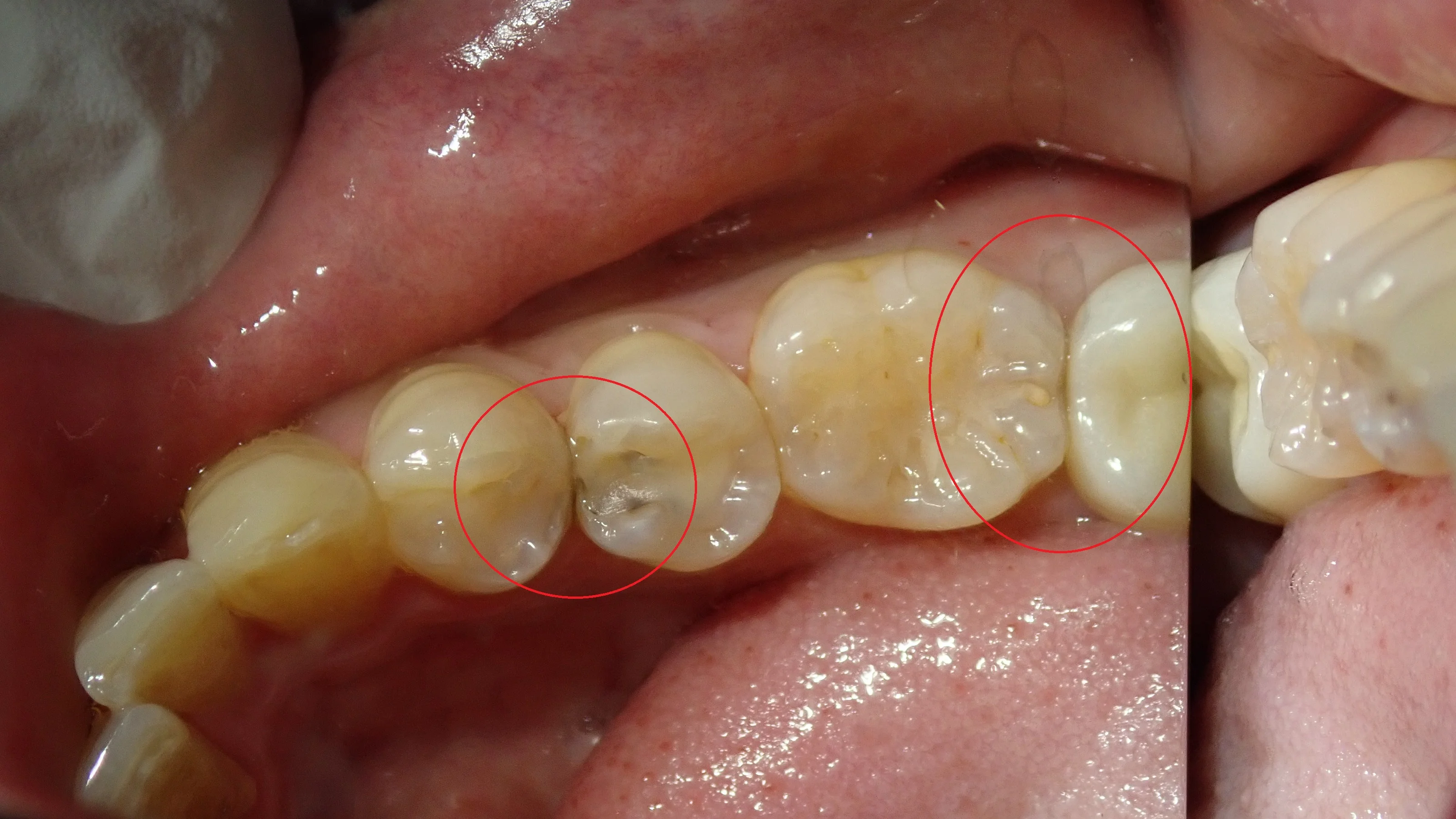 保険の白い詰め物(一気に3本)|坂寄歯科医院(取手市藤代)
