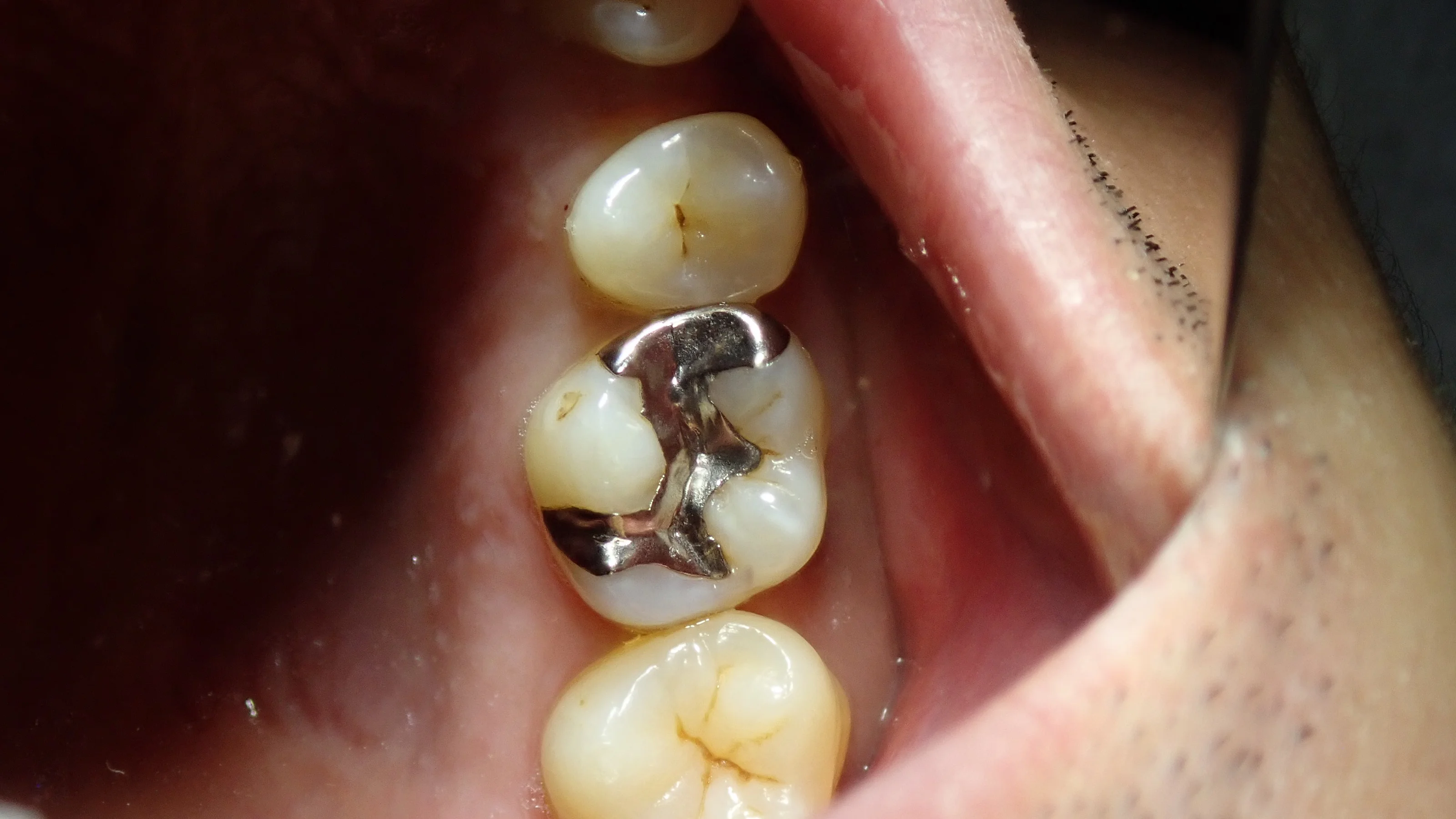 ダイレクトボンディング⑨|坂寄歯科医院(取手市藤代)