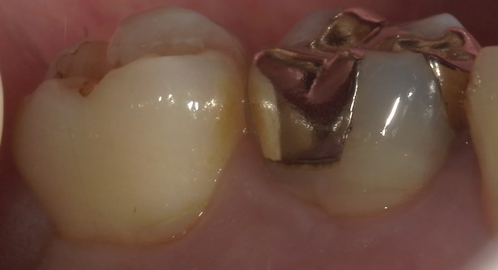 歯の側面も同時に治療したケース。|坂寄歯科医院(取手市藤代) - 画像2
