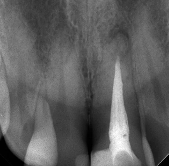 前歯の根管治療|坂寄歯科医院(取手市藤代) - 画像3