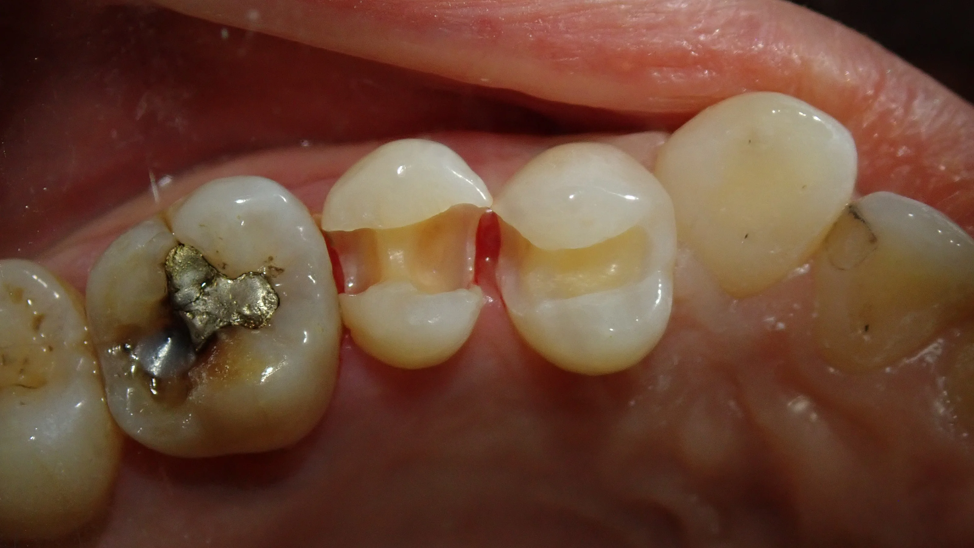 白い部分的な詰め物｜坂寄歯科医院（取手市藤代） - 画像4