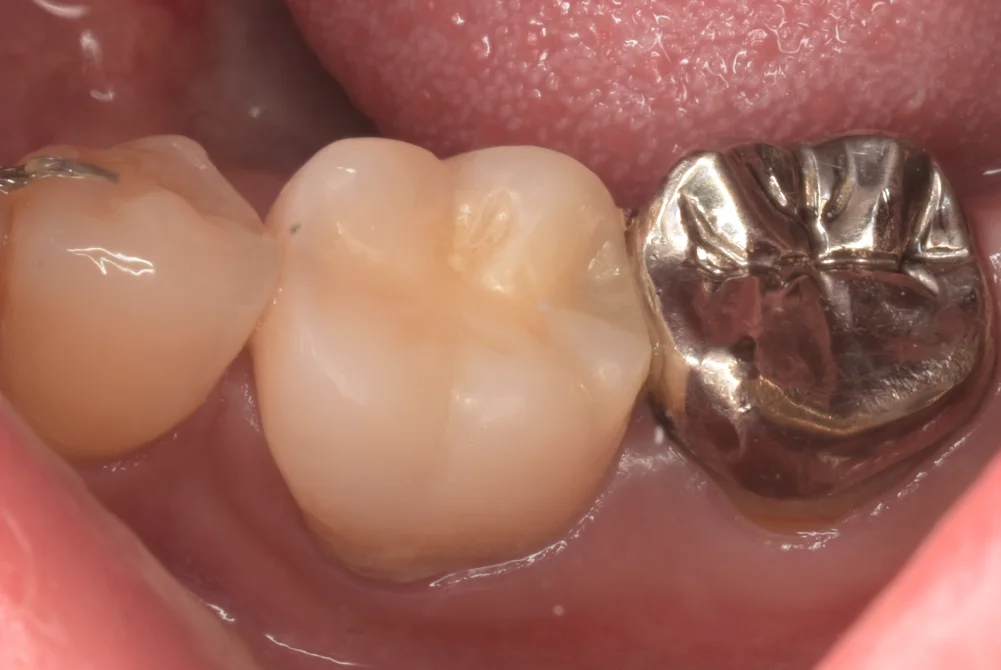 神経の治療後をセラミックで。|坂寄歯科医院(取手市藤代)