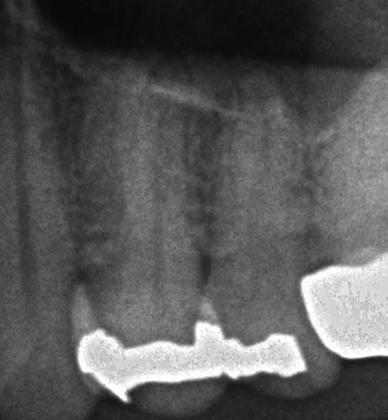 小さい奥歯(小臼歯)の白い詰め物|坂寄歯科医院(取手市藤代)