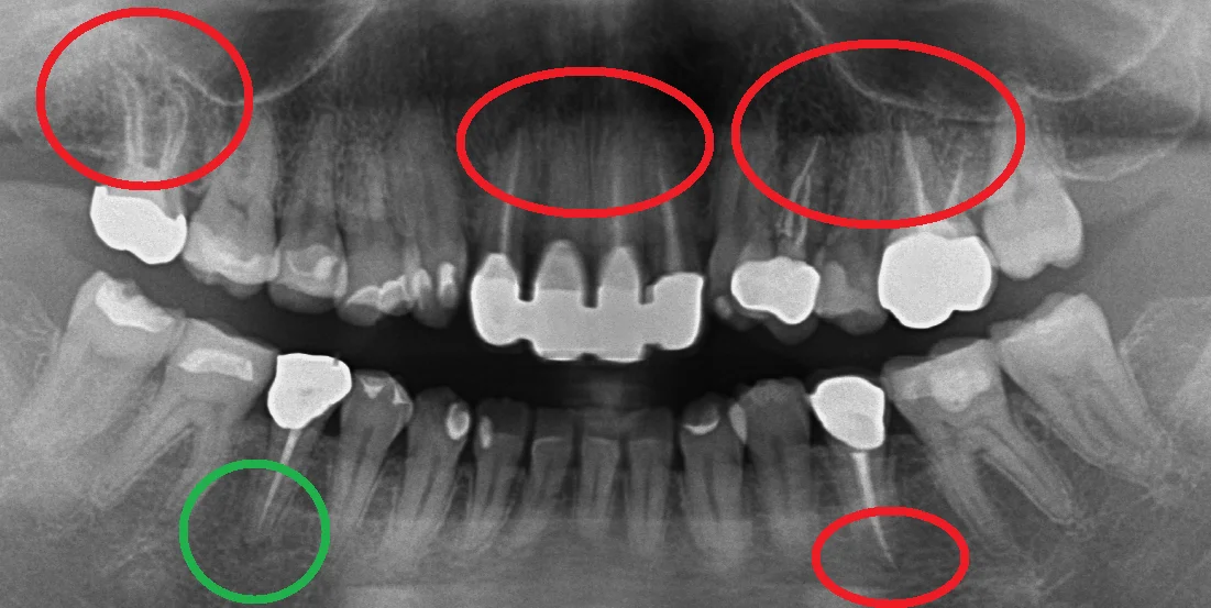 根管治療の成功率について｜坂寄歯科医院（取手市藤代） - 画像2
