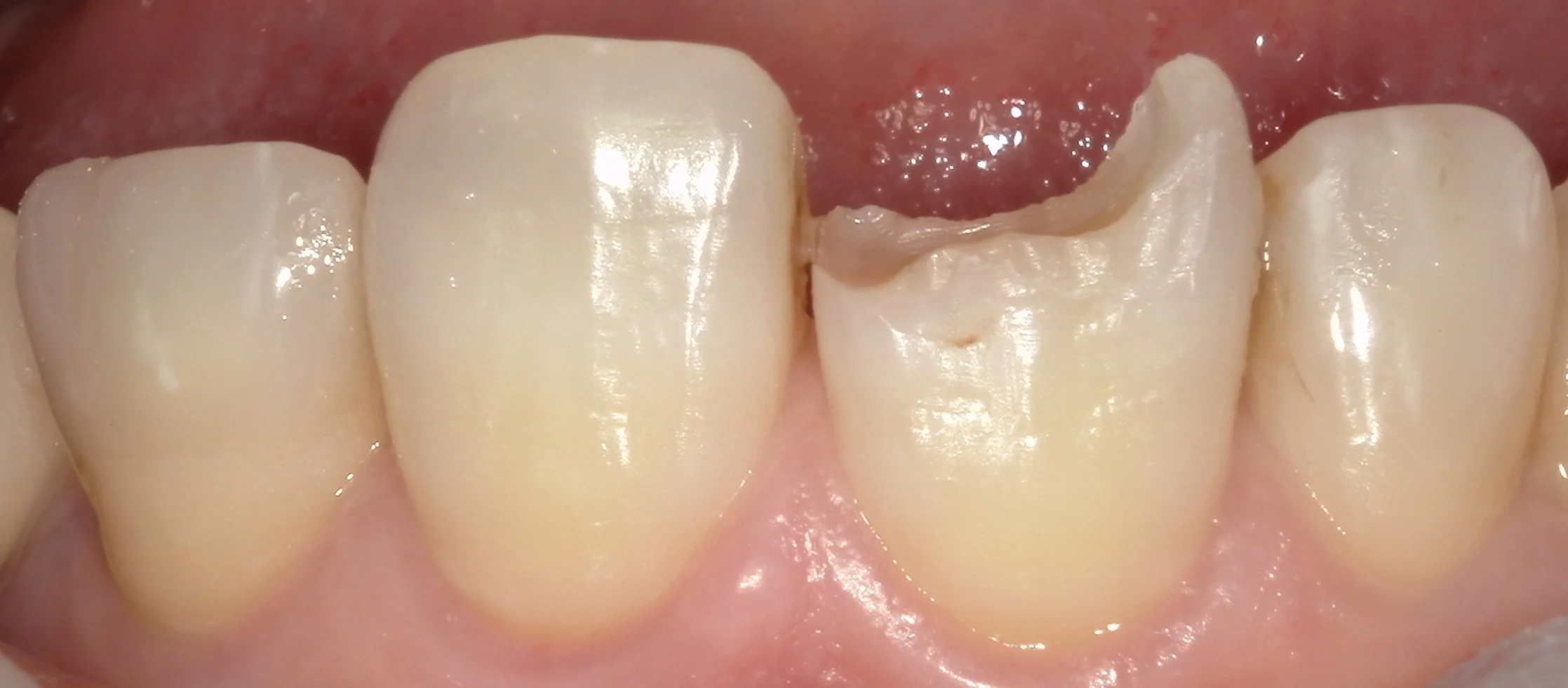 前歯が折れてしまったケース。｜坂寄歯科医院（取手市藤代） - 画像2
